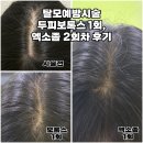 새로나병원 | 동탄탈모병원추천 - 두피보톡스 1회, 엑소좀 2회차 시술 후기 ! 머리카락 새로 나는 듯..?