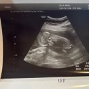 오케이메디 | 거제 엘르메디 자궁무력증 맥도날드 수술 후기