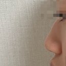 숨온누리약국 | 100% 내돈내산 기증늑+콧대 실리콘 코수술 6일간 찐후기