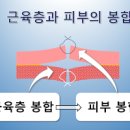 상해 창상봉합술, 근봉합술, 변연절제술 이미지