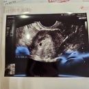 새마음의원 | 임신 5주3일 피비침, 난황 보이는 시기 이천 조윤영여성의원 초음파 마미톡 후기
