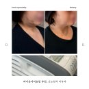 온다 | 신논현피부과 온다리프팅 후기, 탄력 고민으로 방문한 솔직 후기