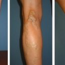 하지정맥류(varicose vein) 이미지