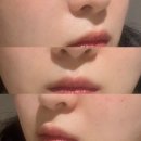 전원말안길 19 | 부산 센텀피부과 팔자주름 미희주사 3차, 내돈내산 찐만족 후기