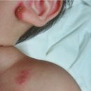 MAST Care(마스트 케어) | 아토피 알레르기 반응 검사, 꼭 해야 할까요? 검사 필요성과 신뢰도 알아보기