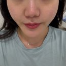 다은메디칼 | 신림 봉천 피부관리 에스테틱다은 극초단파리프팅 후기