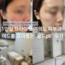 골드 | 여의도 피부과 추천 여드름 효과 좋았던 골드ptt 후기