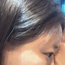 반월당자연사랑약국 | 대구이마필러 5CC 납작이마 살린 후기 / 멍 / 통증 / 관리법 (전/후 사진)