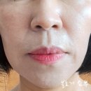 강남대로10길 60-5 (1) | 부산 울쎄라 리쥬란 리니어펌 60대 엄마 시술후기