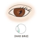 마르판 증후군 (Marfan Syndrome) 이미지