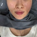 웨이브닷 | 대전 탄방역 피부과 추천 엑셀웨이브 리프팅+볼뉴머 만족 후기