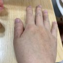 다난 2023상반기 베트남여행 색소침착 식물성광피부염 치료 후기 / 아기열꽃 두돌발진 열감기 가와사키...