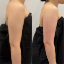 주식회사 케어원 대구지사 | 대구 신부관리 바디 온다리프팅 팔뚝 대만족 솔직후기
