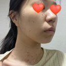 온한의원 | [피부관리] 내돈내산 부산 편평사마귀 제거 잘하는 한의원에서 받고 온 후기
