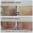 목감맑은에스테틱 | 시흥피부관리 쥐젖(기미잡티)제거+맥슈어(여드름/주름) 1~2주 과정 후기