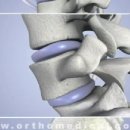 척추분리증 및 척추전위증(Spondylolysis and Spondylolisthesis) 이미지