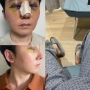 남자 코 성형 수술 붓기 빼는 법 (콧대 실리콘, 매부리코, 코골절)