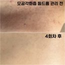 예신 | 송파모공각화증 예신관리 후기, 등드름 아닌 모공각화증