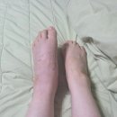 코끼리휴병원 | 리스프랑 인대손상 어쩌구 후기-4탄/심한부종,핀뽑는 수술