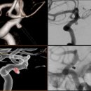 2011년9월29일 비파열성 뇌동맥류 코일색전술 이미지