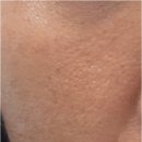 뒤통수 | 제네시스 레이저 가격 내고 뒤통수 맞은 후기(+내돈내받)