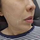 의정부 피부과 슈모드 슈링크 인모드 잘하는 곳 내돈내산 후기
