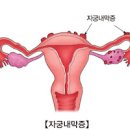자궁내막증 자궁내막증 원인 자궁내막증 증상 자궁내막증 치료 이미지