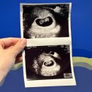 양산일신산부인과의원 | 임신 9주 2일 명지 일신산부인과 서브 병원에서 젤리곰 확인