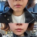 하진에너지 | 청량리피부과 티타늄리프팅 받고 얼굴라인 정리된 후기