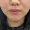 신사역 피부과ㅣ온다리프팅 후기ㅣ팔자주름 효과 좋음