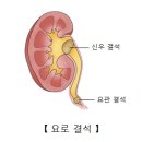 요로결석 이미지