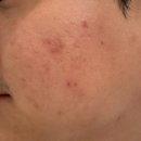 미앤아이 의원 | 성남 피부과 미앤아이의원 여드름 케어 후기(압출,인피니,네오빔)