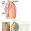 병원에서 통풍진단 받으면 요산수치와 관계없이 통풍진단비를 받을 수 있습니까? 이미지