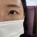 배치 | 강남 눈밑지방재배치 솔직 후기