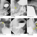 위장 조영술 나팔관 조영술 위 조영술 위내시경과 차이점 초음파 나팔관 조영술 이미지
