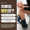 치루개 이미지