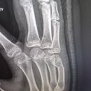 인천더드림병원 | 인천더드림병원에서 중학생아들 오른손골절 수술후기