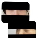 가울파트너스 | 눈밑지방재배치 한달 실제 후기 (부작용,붓기,전후,통증,멍 등)