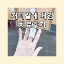 깊게 베였을때&gt;접합,봉합,미세수술 전문_전주수병원!피엠블리 수술 후기와 상처회복에 도움되는 영양제추천
