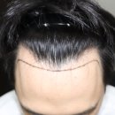 머리카락이식 시 꼭 알아두여야 할 정보에 관한 글