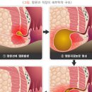 치루증상 치루 치핵 치루 원인 치료 이미지