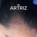 리즈 헤어 - 무안군 | 김포두피문신 아트리즈 후기, 5년 고민 M자 헤어라인 3회 만에 자연스럽게 채웠어요!