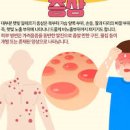 햇빛 알레르기 햇빛 재채기 난다면? 화상, 열감 방법 이미지