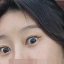 목포장문외과병원 | 종로 성형외과 앙코르 눈밑지 눈밑지방재배치 3개월 후기 효과