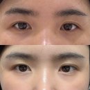 리아 | 리아이프팅 2차 리터치 후기! 눈썹실리프팅 &amp; 눈꼬리리프팅 최종장!!