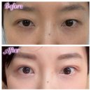 공감성형외과의원 | 피알성형외과 쌍커풀 눈매교정 재수술 내돈내산 후기👀 쌍수 재수술 후 한달 뒤 전후 비교‼️