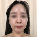 [신사 피부관리] 디토뷰티샵 후기, 수분 리프팅으로 화잘먹 웨딩관리