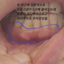 16년간 마루타. 최근 6년째 극살인고문. 잇몸 염증이 심하고 잇몸이 녹아내리고 치아가 길어짐. 최근 6년간의 큰 변화임. 이미지