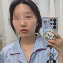 빨간입술 | 강남역성형외과 입술필러 후기 자연스러운 0.4cc변화