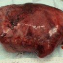 CardiopulmonaryBypass to Facilitate Excision of a Giant Pleural Tumour 이미지